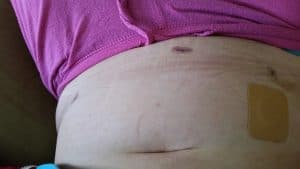 1 day after surgery